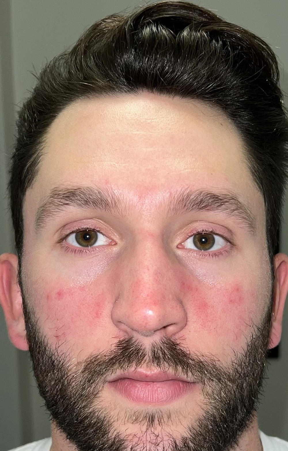 Kevin on day 1 of using Revival, with visible redness across his cheeks and nose.